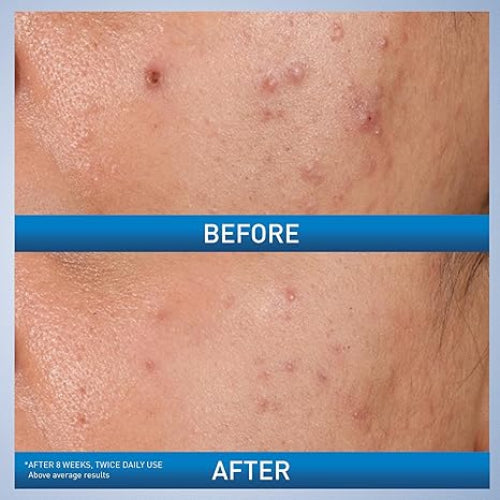 CREMA CONTROL ACNE NOCHE 40ML - CERAVE - Adrissa Beauty - Cuidado de la piel